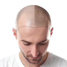 Load image into Gallery viewer, HAIR TRANSPLANT PACKAGE